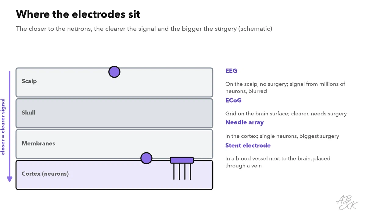 Cross-section from the scalp to the brain: EEG electrodes sit on the scalp, ECoG grids on the surface of the brain, needle arrays inside the cortex and stent electrodes in a blood vessel; the deeper, the clearer the signal and the bigger the operation